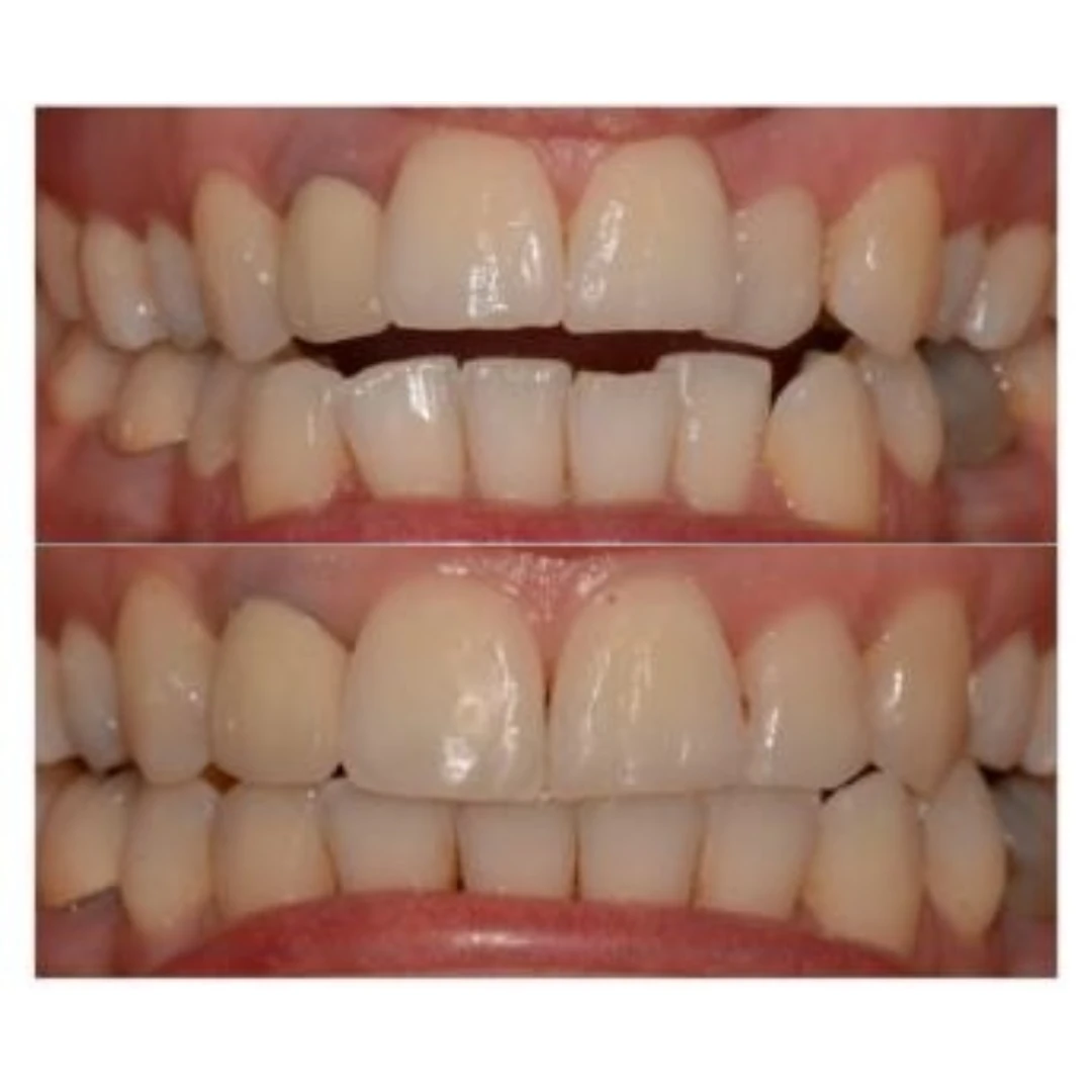 Uneven front teeth ad creative
