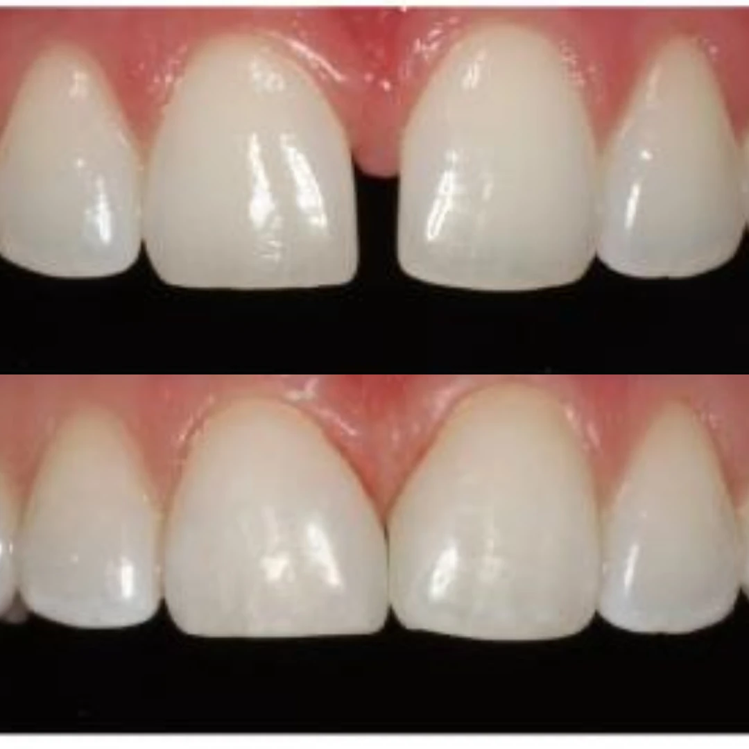 Considering porcelain veneers ad creative